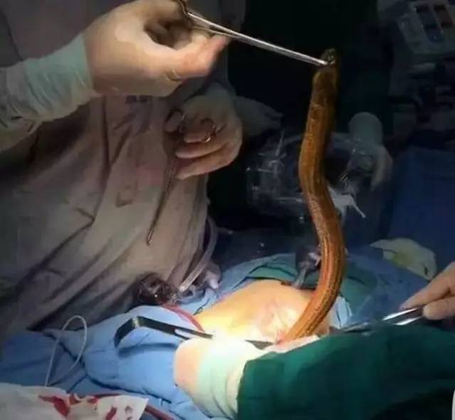 恐怖!手术从腹部取出黄鳝.