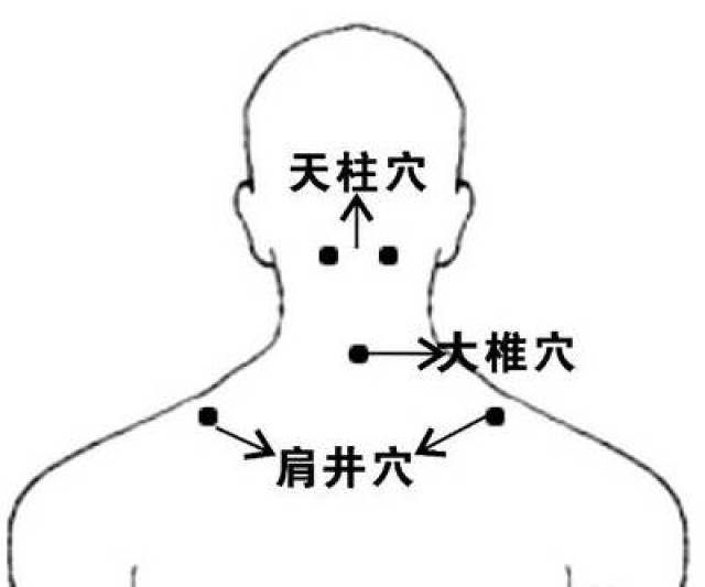 拔罐治疗落枕的拔罐方法