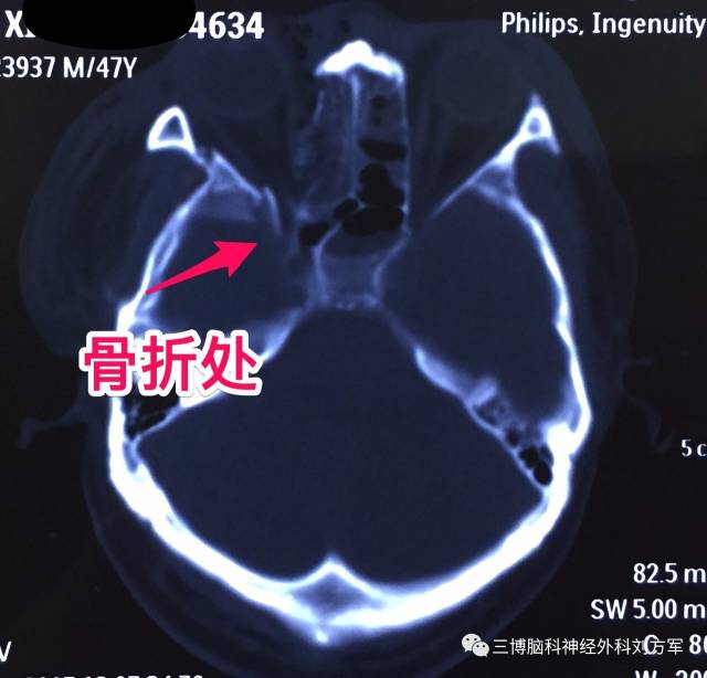 右侧额颞开颅硬膜外经眶上裂入路视神经管减压术