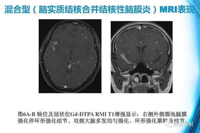 【影像病理】颅内感染性疾病-结核性脑膜炎,结核瘤