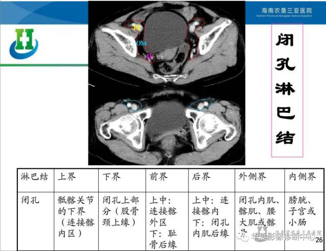 盆腔淋巴结的影像解剖及临床应用!