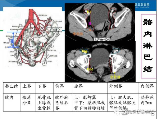 盆腔淋巴结的影像解剖及临床应用!