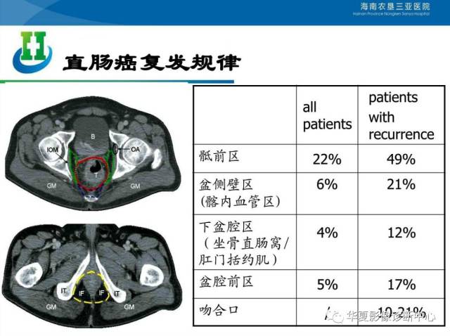 盆腔淋巴结的影像解剖及临床应用!