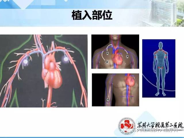 静脉输液港植入技术及围手术期的维护