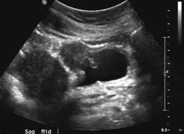 子宫内膜异位于膀胱时的影像学特征