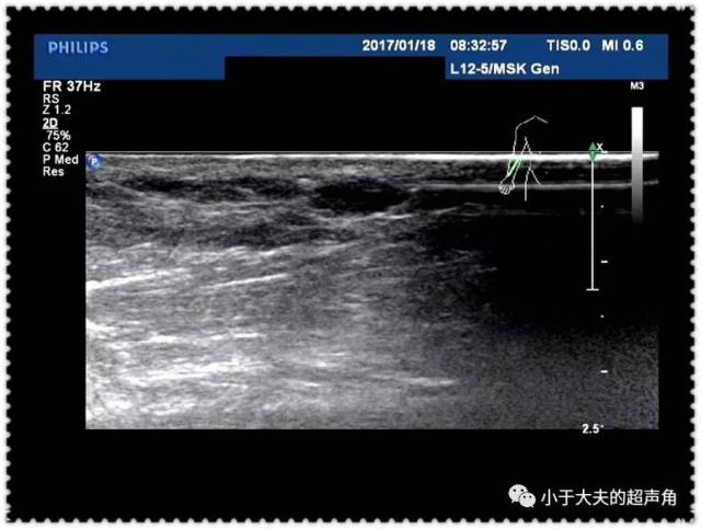 【超声】血管脂肪瘤 angiolipoma【病例分享】