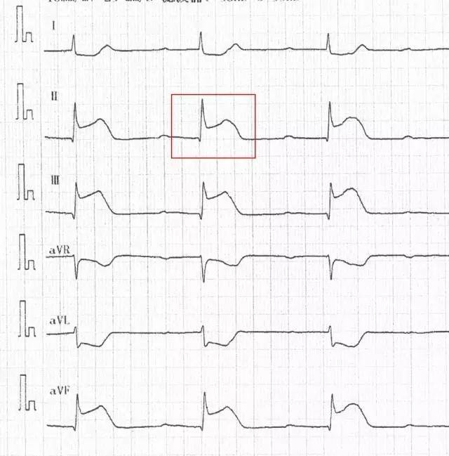 心梗患者心电图图像典型特征,俗称"红旗飘飘"