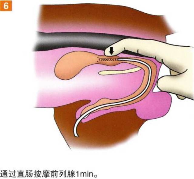 你所不知道的前列腺冲洗