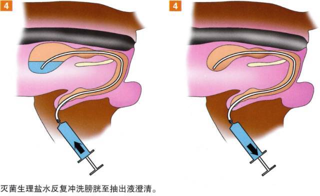 8.将尿管插入膀胱,抽出其中液体. 9.