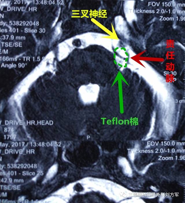 核磁显示:左侧三叉神经及小脑下前动脉关系密切.诊断:左侧三叉神经痛.