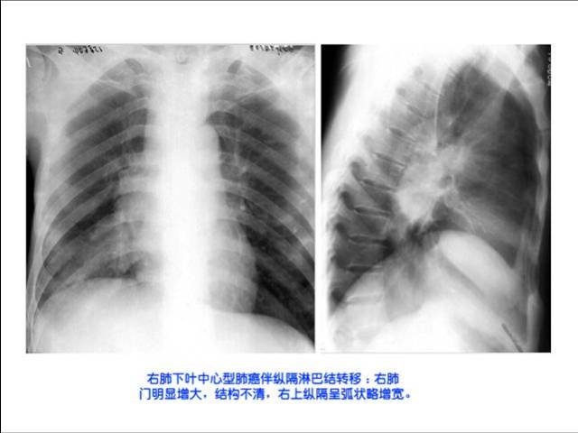 照片名称:右肺下中心型肺癌伴纵膈淋巴结转