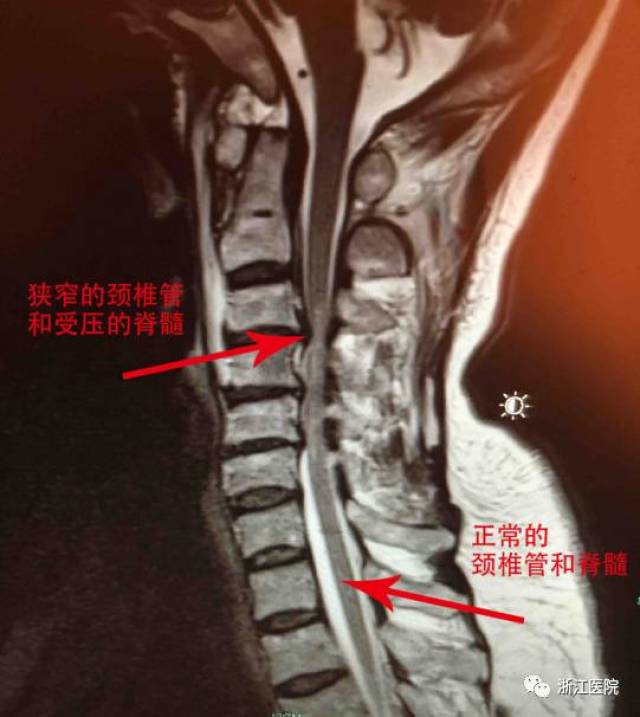 △方大妈的磁共振图 经检查发现,这是典型的脊髓型颈椎病(轻微外伤