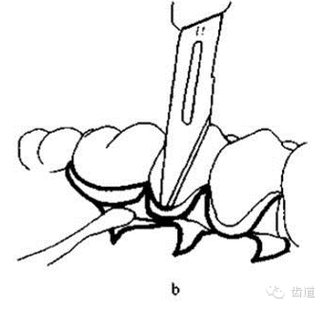 【牙医学堂】牙周改良widman翻瓣术的切口设计