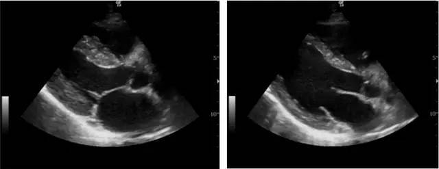 左心室高动力改变(左图为收缩期,右图为舒张期)