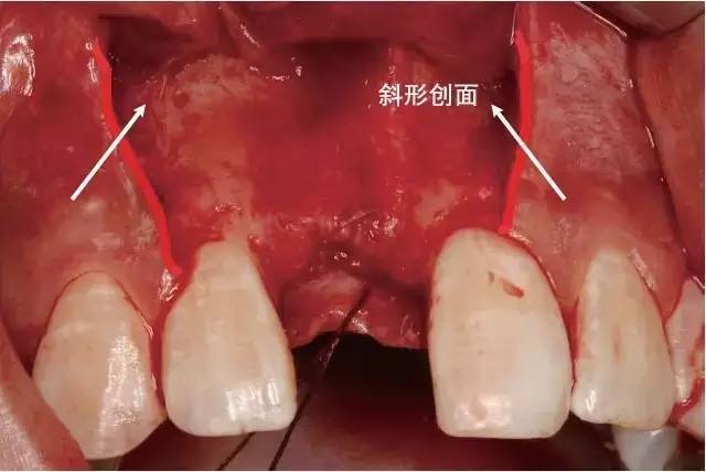 【牙医学堂】图解口腔种植翻瓣术切开步骤