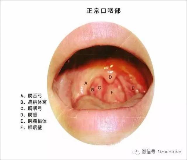 【案例分享】臭氧抗菌剂用于治疗慢性咽炎