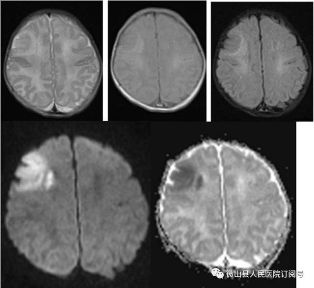【医教研】磁共振弥散加权成像(dwi)在急性脑梗死诊断