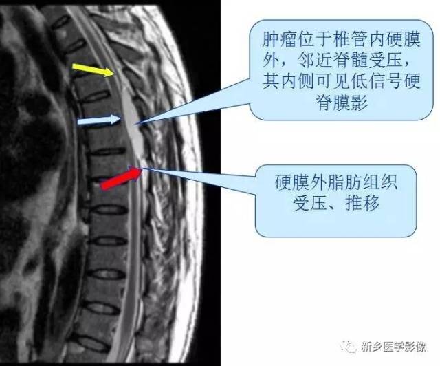 有了这张图,轻松诊断椎管内占位