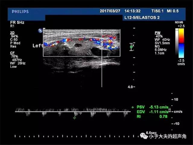 频谱多普勒:肿物内可探及动脉血流频谱,psv=5.1cm/s,ri=0.78.