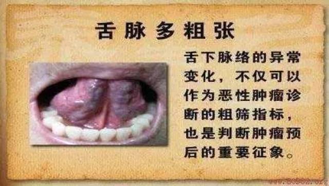 看舌苔辨别癌症早期征兆