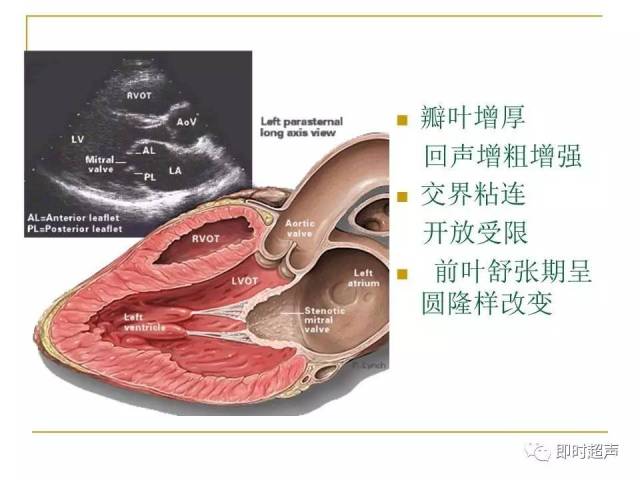 心脏瓣膜病超声诊断