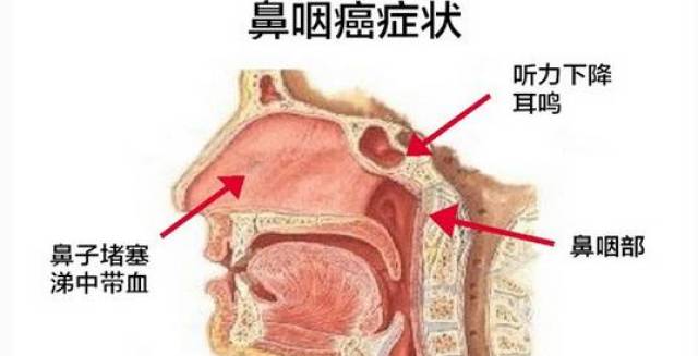 扬州30岁奶爸喉咙疼,鼻涕带血,一查竟是鼻咽癌!就因为