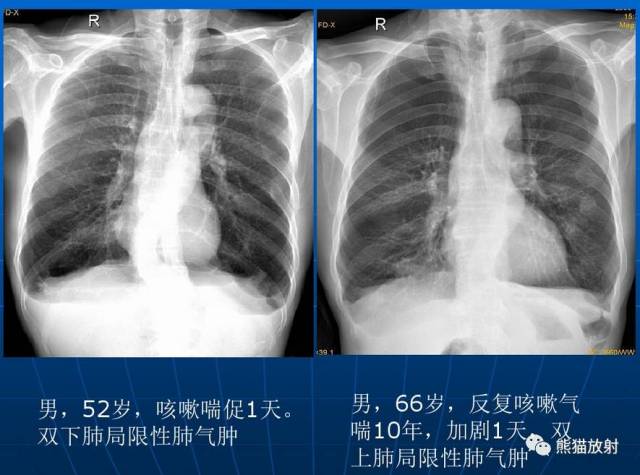 【x线诊断要点】关于"肺气肿"的一些概念,需要熟悉!(结合ct)