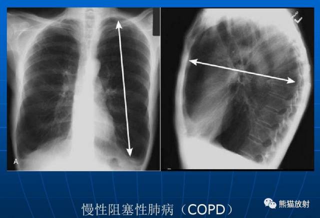 【x线诊断要点】关于"肺气肿"的一些概念,需要熟悉!(结合ct)