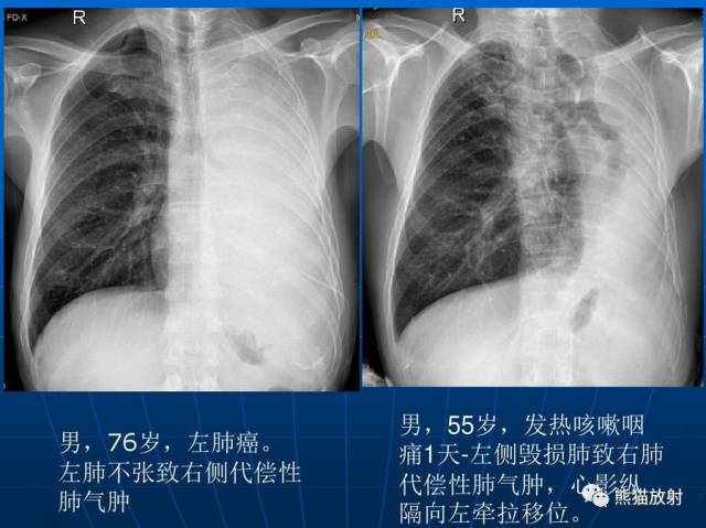 【x线诊断要点】关于"肺气肿"的一些概念,需要熟悉!(结合ct)