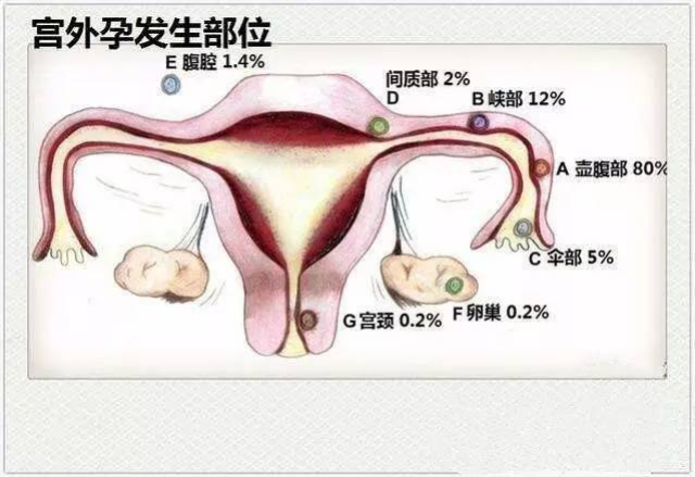 什么是【宫外孕】