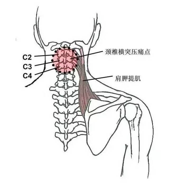 五,颈椎棘突压痛点