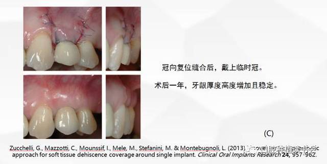 相关的细节包括): (a)手术时移除了冠和基台 (b)采取将游离龈瓣去上皮