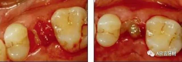 拔牙后3～4天,上皮自牙龈缘开始向血凝块表面生长,但在24～35天,乃至