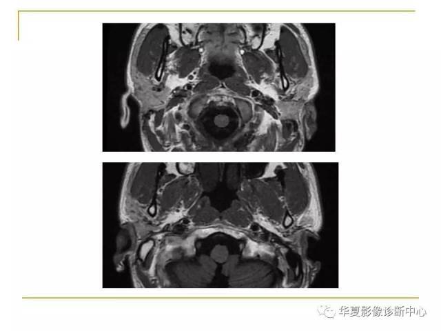 (干货)腮腺混合瘤mri诊断