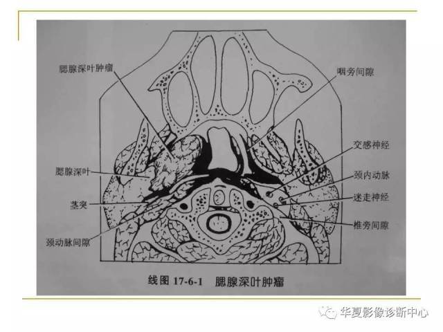 (干货)腮腺混合瘤mri诊断