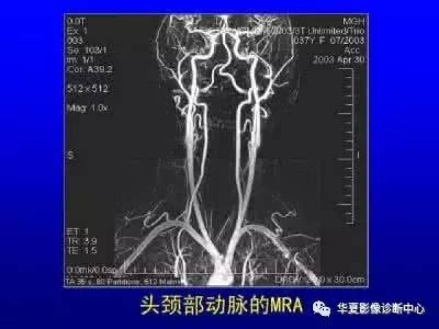 你可能不知道的磁共振血管成像技术