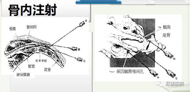 小儿骶管麻醉