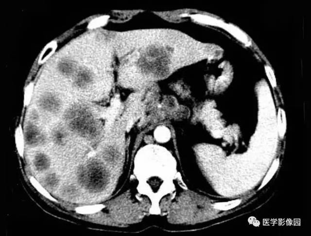 第六章 腹部 第二节 肝脏病变 五,肝脏转移瘤丨精品连载