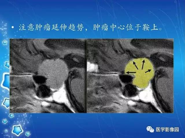 蝶鞍区域病变影像诊断与分析策略| 影像天地