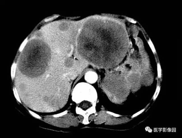 第六章 腹部 第二节 肝脏病变 五,肝脏转移瘤丨精品连载