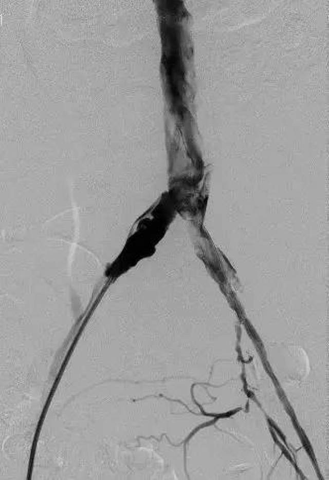 【经典病例】aegis分叉型大动脉覆膜支架治疗主髂闭塞病变——福建