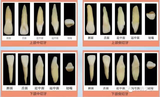 2,上颌侧切牙:为切牙中唇面最突,舌窝最深,远中切角最为圆钝者.