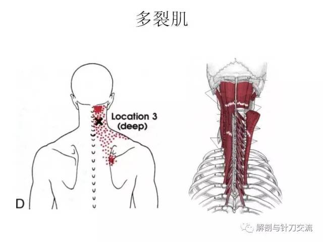 头夹肌和颈夹肌的激痛点解除【视频 】