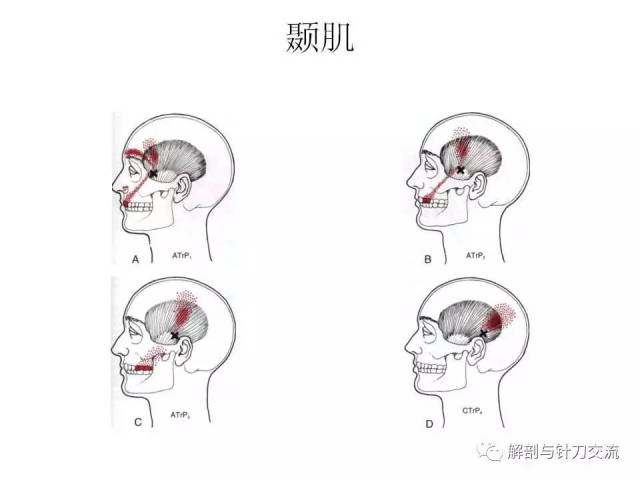 头夹肌和颈夹肌的激痛点解除【视频 】