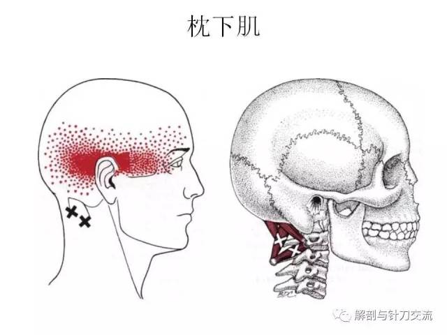 头夹肌和颈夹肌的激痛点解除【视频 】