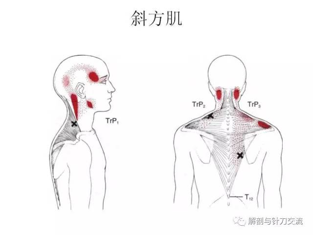 头夹肌和颈夹肌的激痛点解除【视频】_手机搜狐网