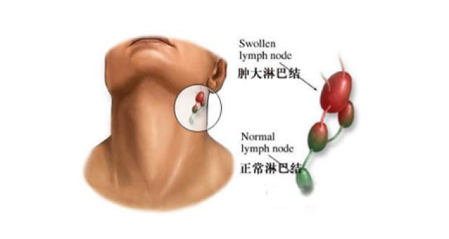 淋巴淤堵不容忽视!