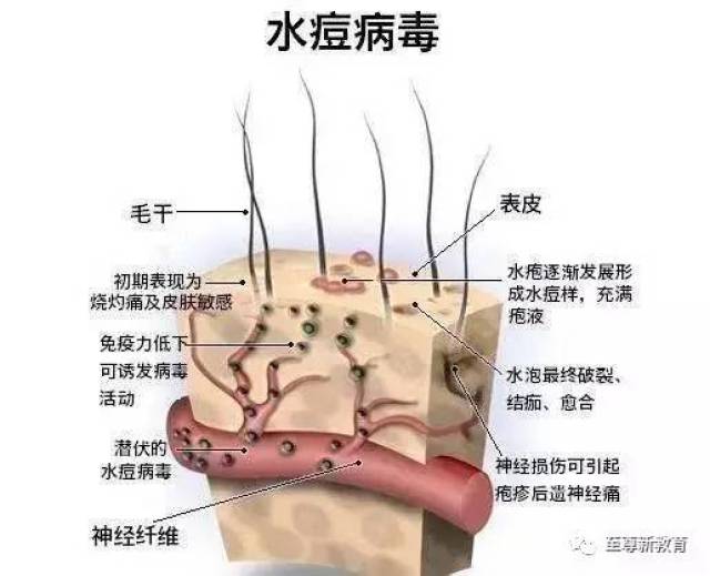 至尊保健|儿童水痘防治