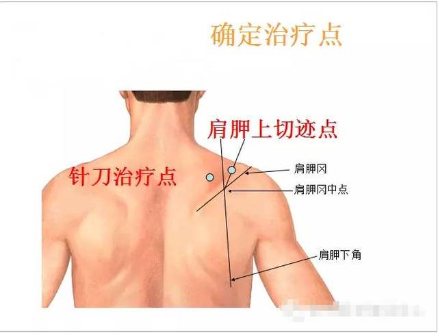 肩胛上神经卡压综合征的针刀治疗——新理念