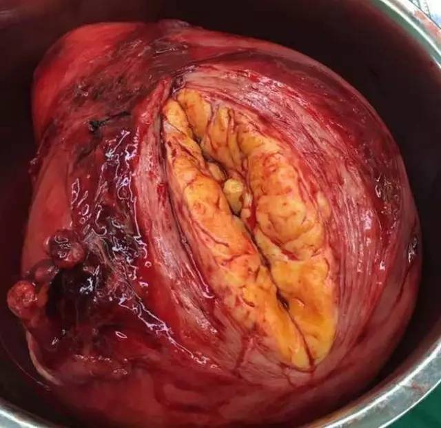 这个大肿瘤在患者肚子里长了两年,整整一大盆!